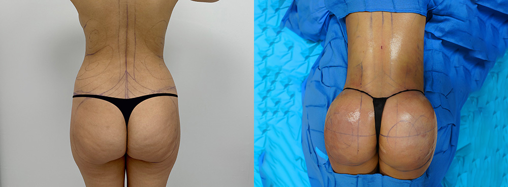 Brazilian Butt Lift Before and After