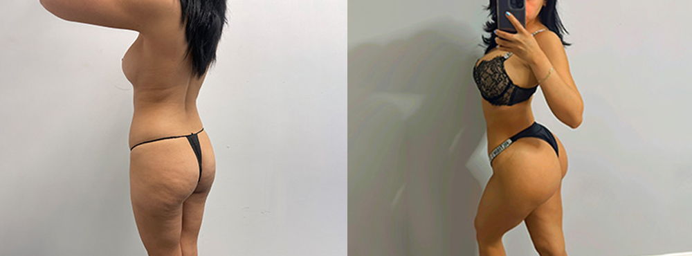 Brazilian Butt Lift Before and After