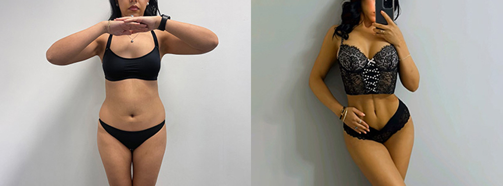 Brazilian Butt Lift Before and After