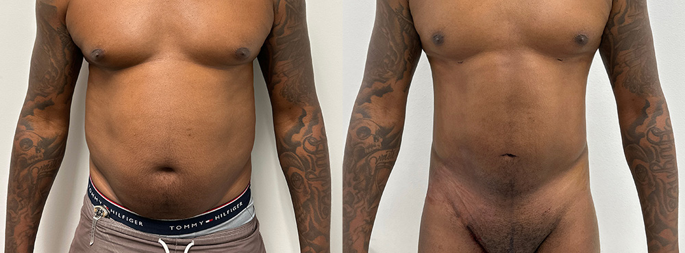 Lipo 360 Before and after