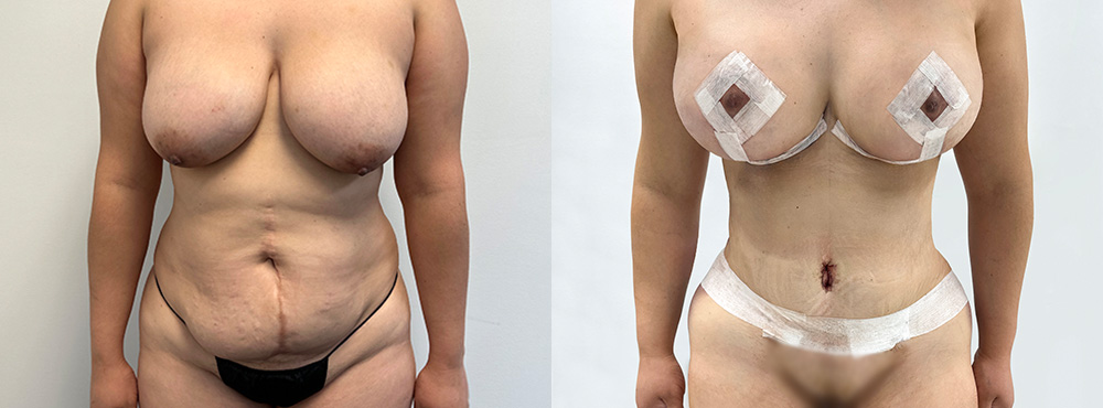 Mommy Makeover Before and After