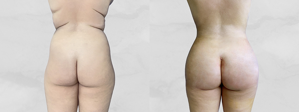 BBL before and after