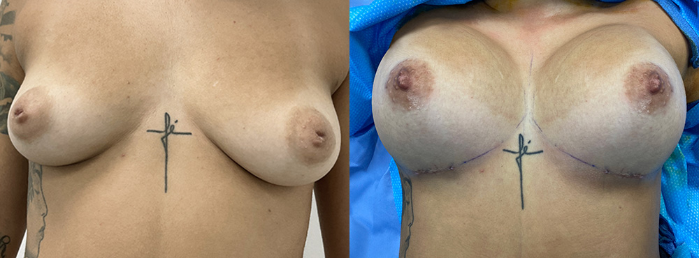 Breast Augmentation Before and After