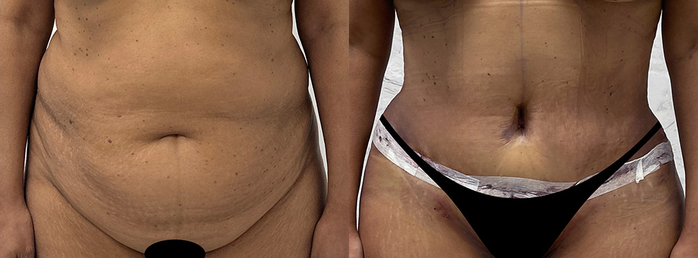 Tummy Tuck Before and After