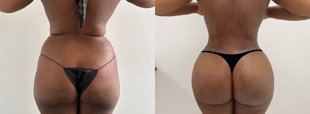 Brazilian Butt Lift Before and After