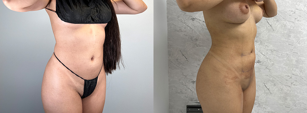 Brazilian Butt Lift Before and After