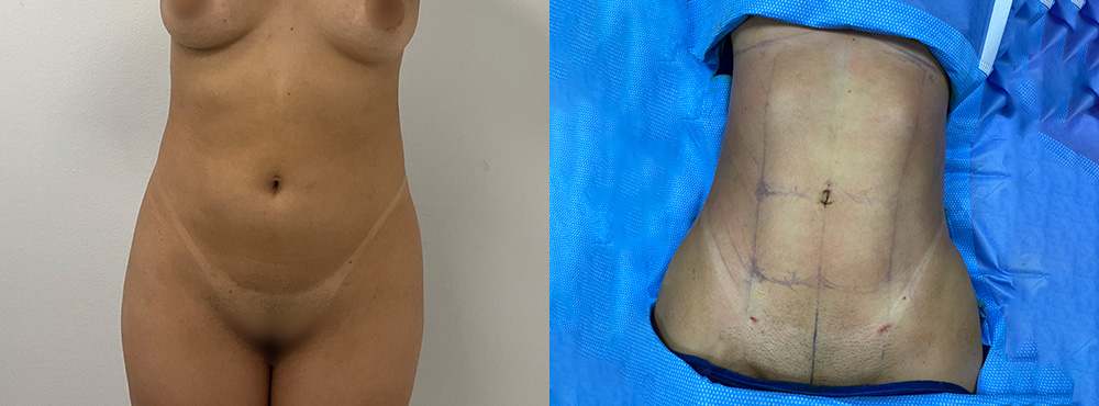 Brazilian Butt Lift Before and After