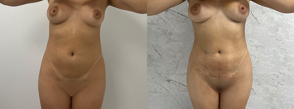 Brazilian Butt Lift Before and After