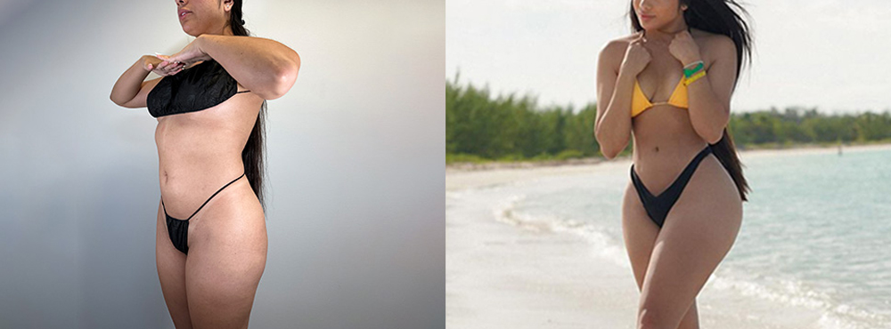 Brazilian Butt Lift Before and After