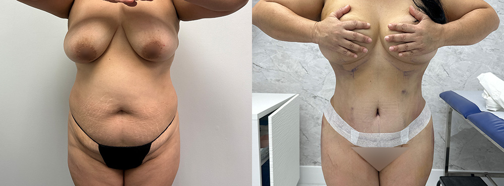 Tummy Tuck Before and After