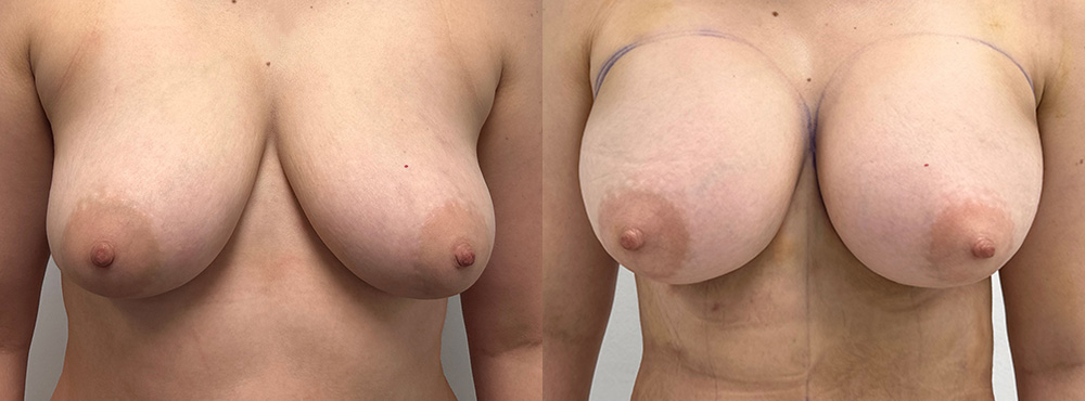 Breast Augmentation Before and After