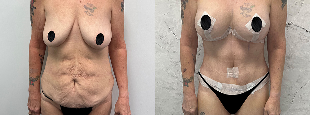 Mommy Makeover Before and After