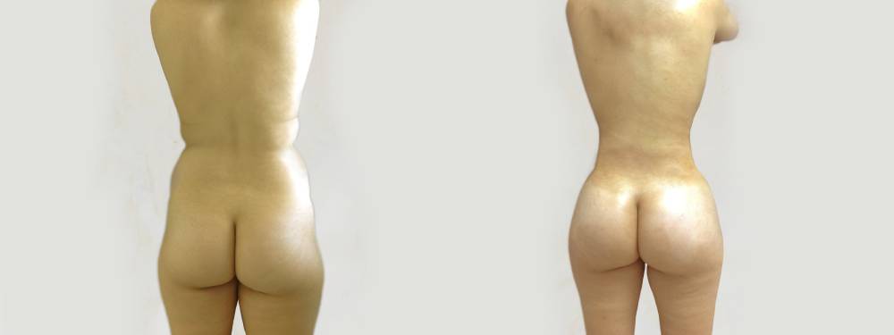 BBL before and after