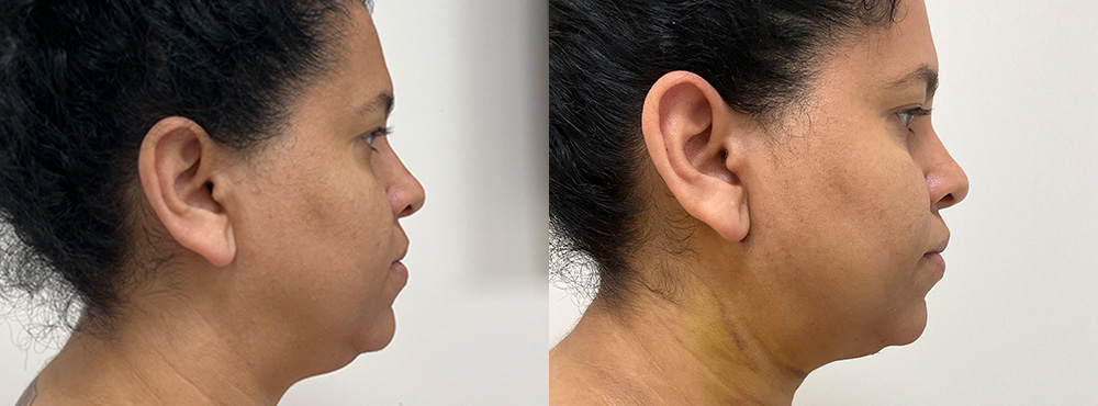 chin lipo before and after