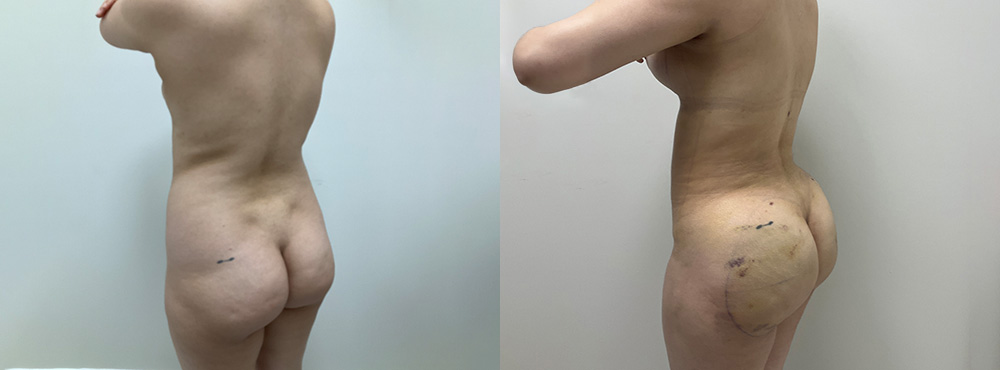 Mommy Makeover Before and After