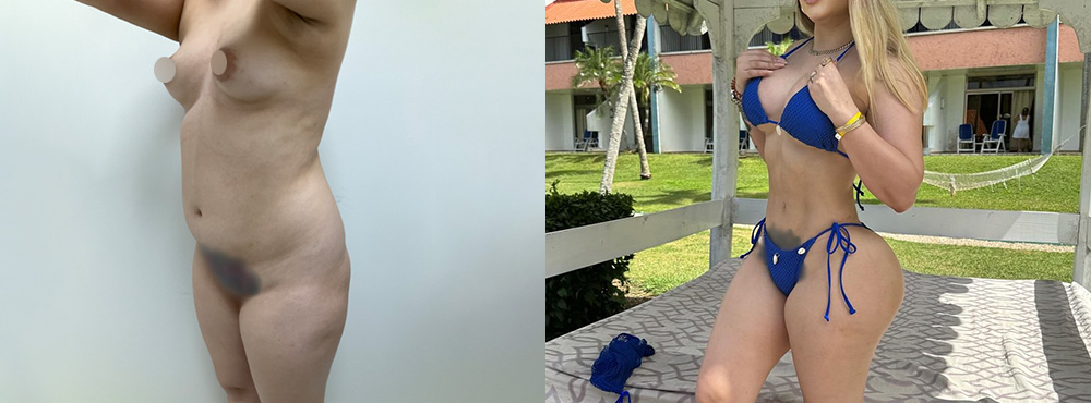 Mommy Makeover Before and After