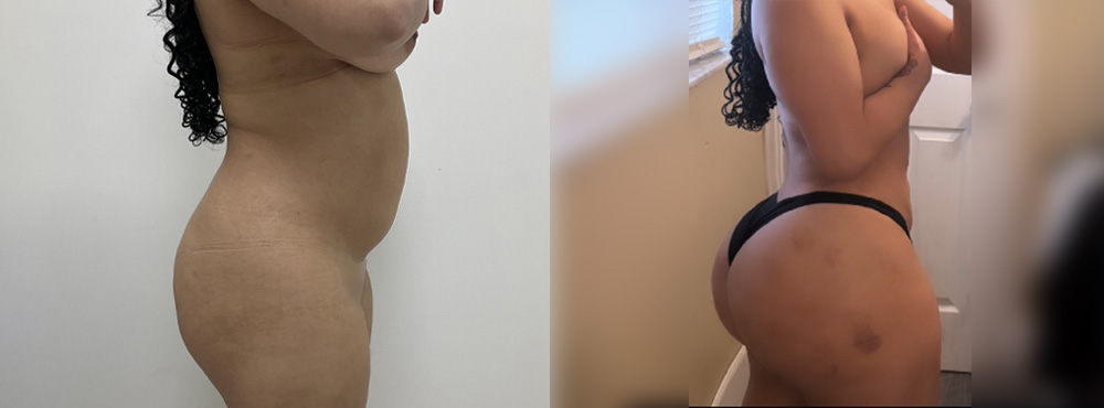 Butt Lift Before and After