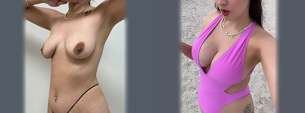 Breast Lift Before and After