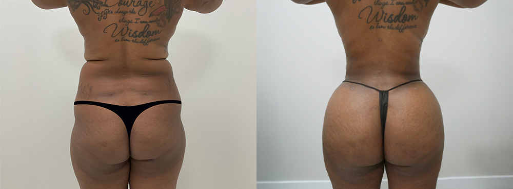 BBL Before and After