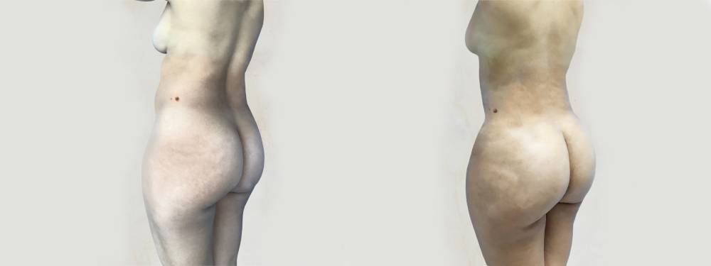 BBL before and after