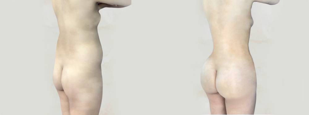 BBL before and after