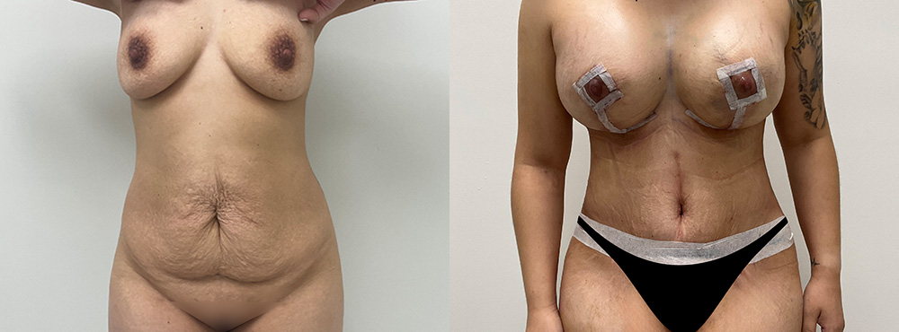 Mommy Makeover Before and After