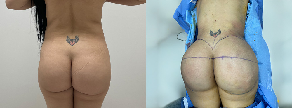 BBL before and after in miami