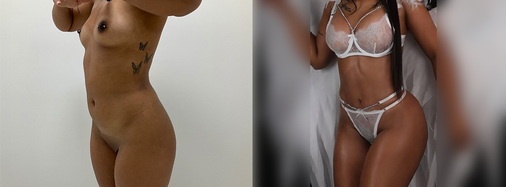 Butt Lift Before and After