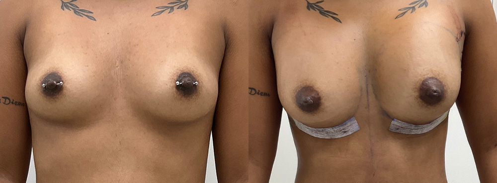 Breast Implant Before and After