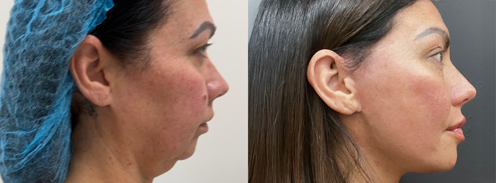 Neck Lift before and after
