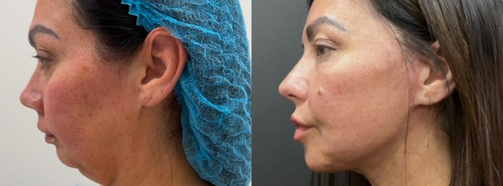 Neck Lift before and after