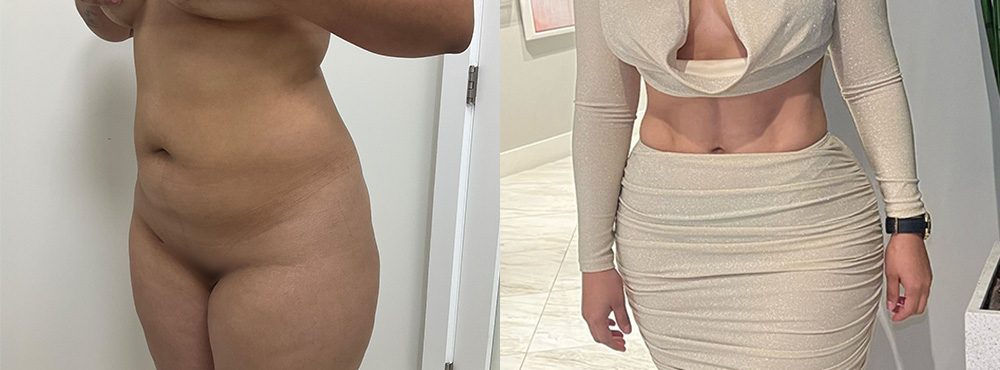 BBL before and after