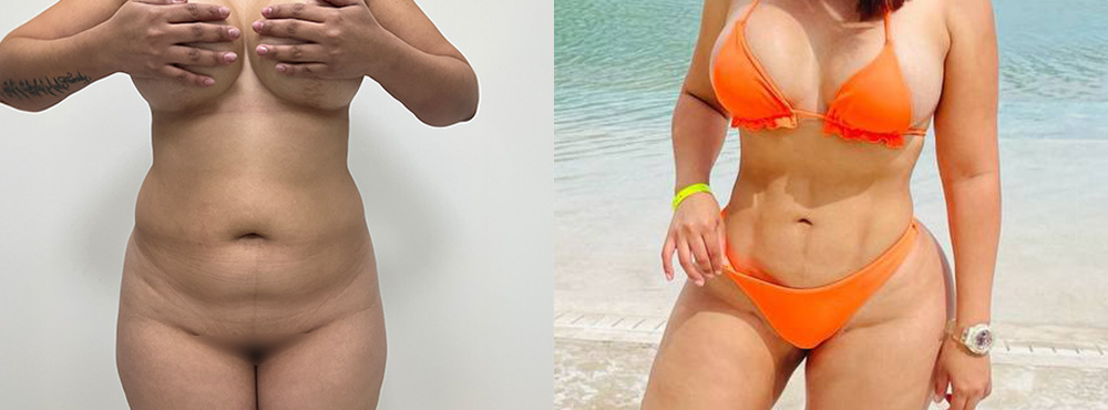 BBL before and after