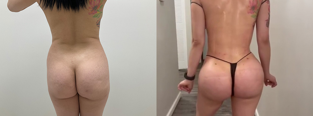 BBL Before and After