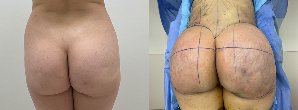 BBL Before and After