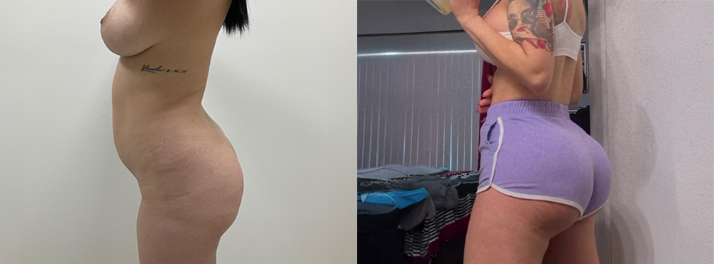 BBL Before and After