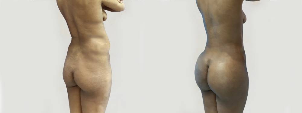 BBL  before and after