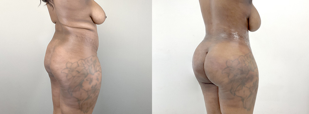 BBL Before and After