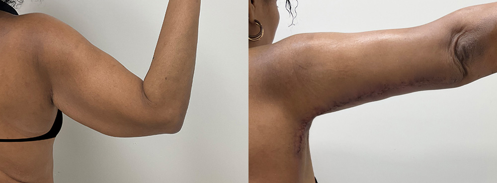 Arm Lift Before and After in miami