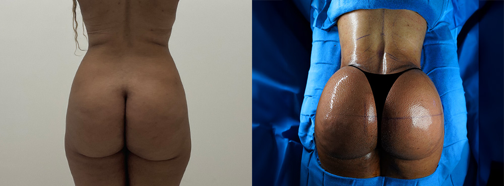 BBL Before and After in miami