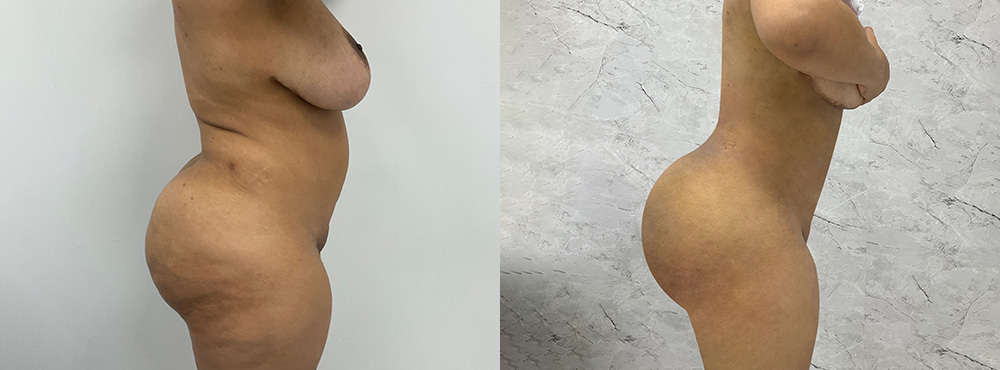 BBL Before and After