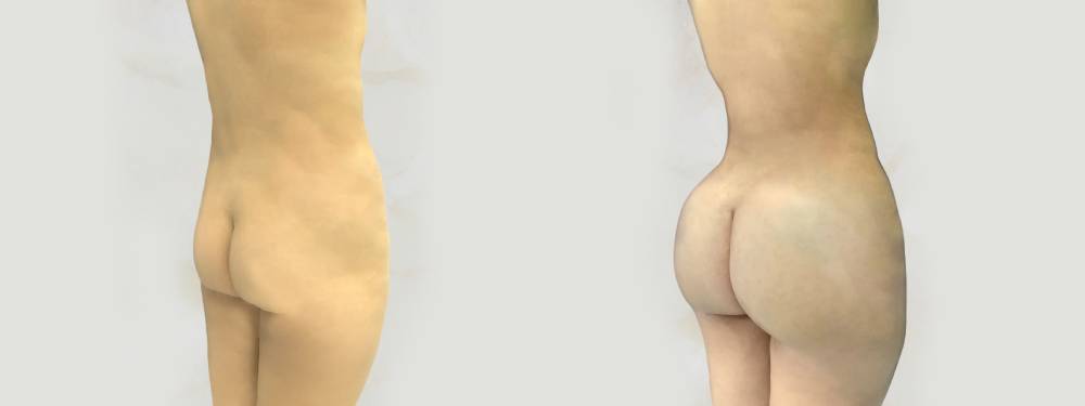 BBL before and after