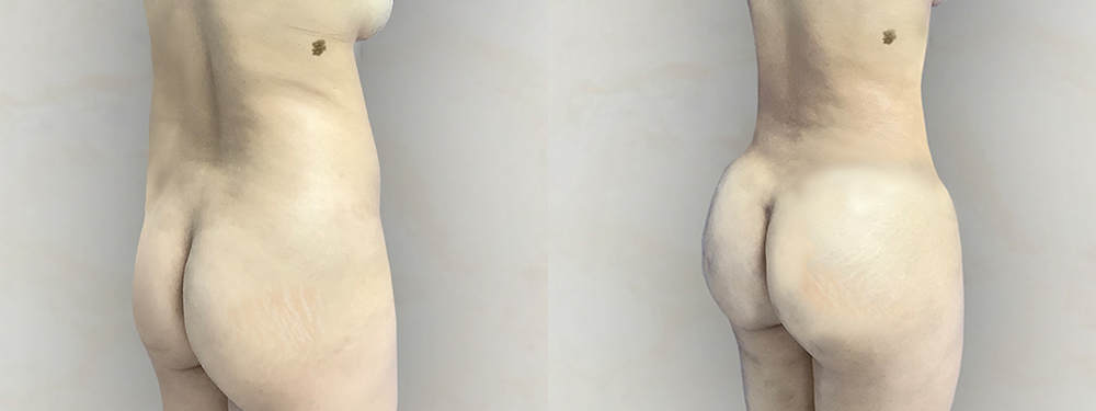 BBL before and after