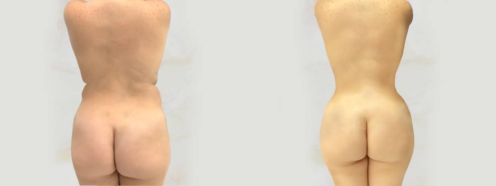 BBL before and after