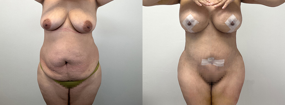 Mommy Makeover  Before and After