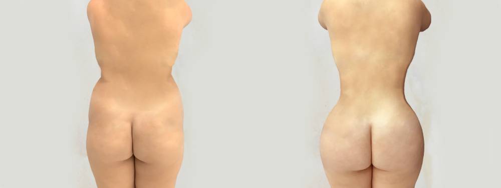 BBL before and after