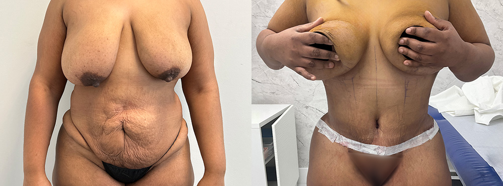 Tummy Tuck Before and After