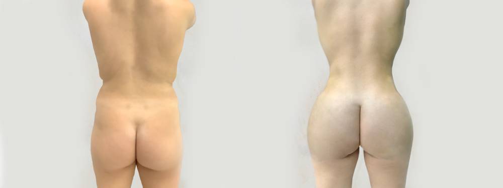 BBL before and after