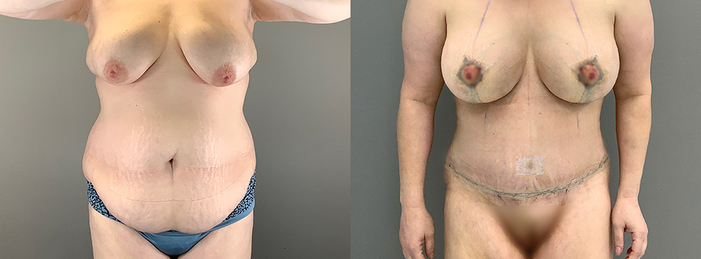 Mommy Makeover Before and After