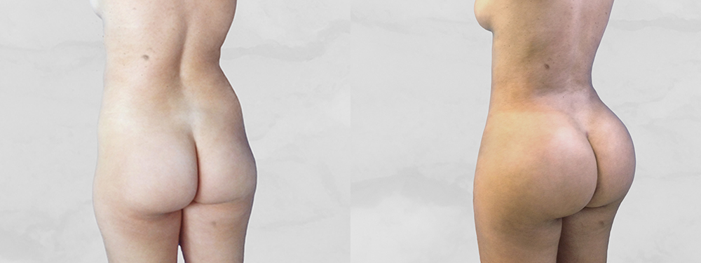 BBL before and after